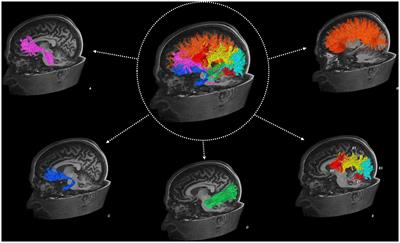 The relationship between cognition and white matter tract damage after mild traumatic brain injury in a premorbidly healthy, hospitalised adult cohort during the post-acute period